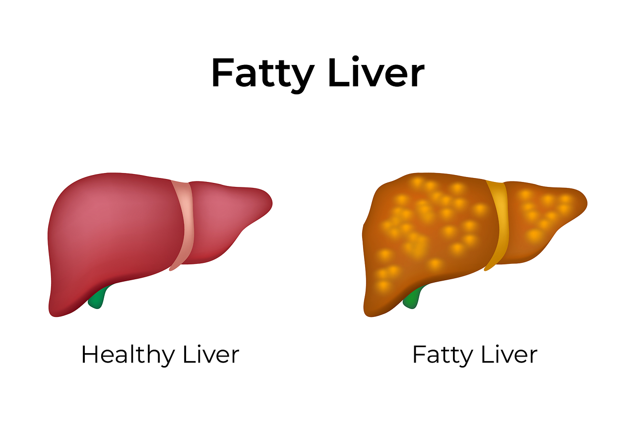 Treatment for Fatty Liver Disease: A Complete Patient Guide